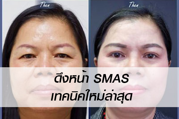 ดึงหน้า SMAS เทคนิคใหม่ล่าสุด